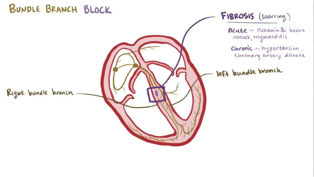 heart disease left bundle branch block​